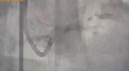 Procedurile intervenționale realizate în Complexul Clinic Augusta din Debrecen