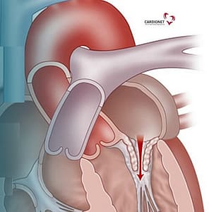 Chirurgie cardiacă, chirurgie valvulară, valva mitrală