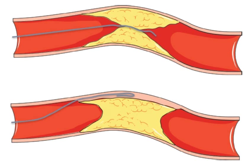 Tehnica CTO (Chronic Total Occlusion)